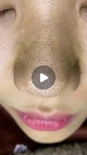 Big Cyst on Instagram: "LINK IN BIO FOR FULL VIDEO. . . Follow us  @popmypimple2022 for more pimple popping videos #pores #acne #skincare #blackheads #pimples #whiteheads #pimple #blackhead #skin #beauty #blackheadextraction #blackheadremoval #pimplepopping #whitehead #pimplepop #pimplepoppers"