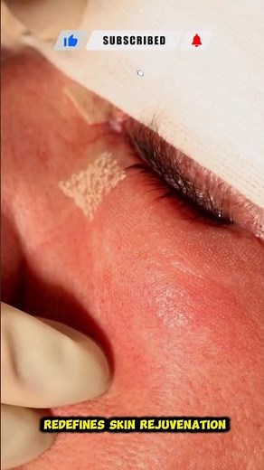 CO2 Ultra Pulse Alpha Laser: Skin Rejuvenation, Tightening, and Collagen Renewal ✨