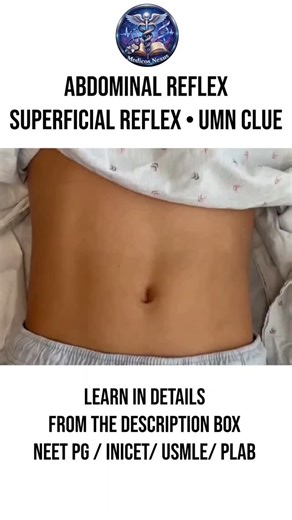 Medicos Nexus | 🧠🩺 ABDOMINAL REFLEX The abdominal reflex is a superficial cutaneous reflex elicited by stroking the skin of the abdomen, resulting in... | Instagram