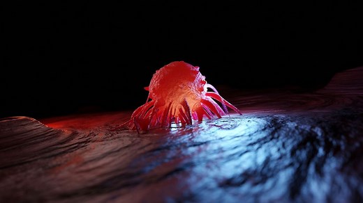 Liposarcome : une tumeur des cellules graisseuses