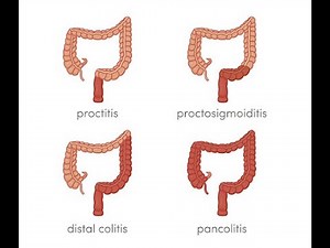 Proctosigmoiditis ; Definition, Types, Causes, Symptoms, Diagnosis, Treatment