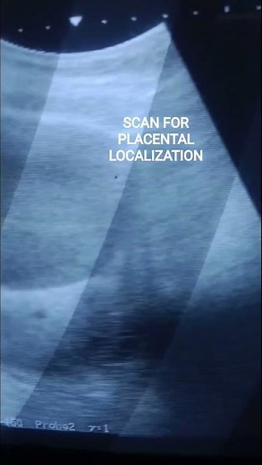 ULTRASOUND FOR PLACENTAL LOCALIZATION PLACENTA PREVIA #placentapositionduringpregnancy