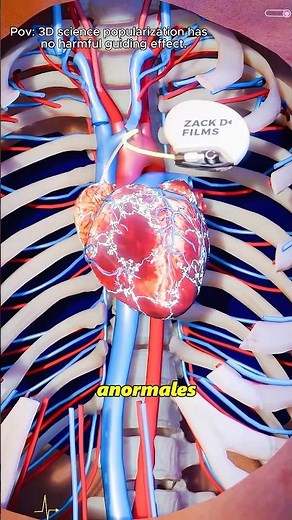 How heart pacemaker works?#pacemaker#Heartproblems#3Danimation#3dmedicalanimation