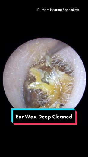 Deep Clean Your Ears for Better Health