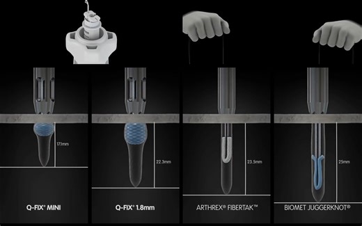 施乐辉Q-FIX全缝线锚钉肩关节操作演示动画
