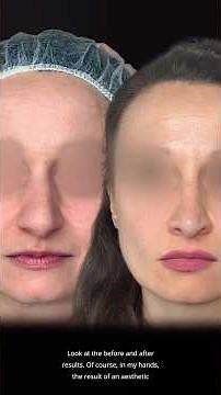 Natural rhinoplasty: the secret is in the supratip