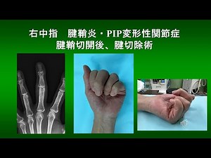 右中指 腱鞘炎・PIP変形性関節症 腱鞘切開後、腱切除術（2025.9）