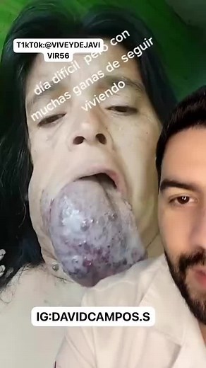 Understanding Hemangioma: Causes, Symptoms, and Treatment