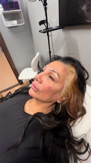 Full face balancing 💉 #booknow📱📲 #houston #botox #filler | face