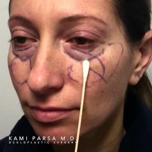 Trifecta Lift | Blepharoplasty, Fat Injection, Laser Resurfacing | How to Get Rid of Dark Circles