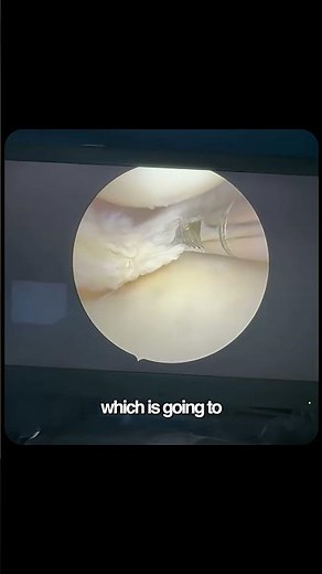 Knee surgery instrument- Arthroscopic shaver !! #arthroscopicsurgery