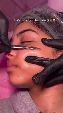 Dermaplaning gently exfoliates the skin and removes peach fuzz, leaving a smoother and brighter