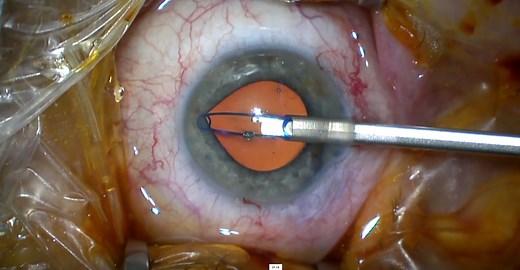 Malyugin Ring 7.0 Surgical Technique - Eyetube