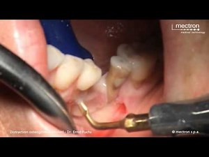 Piezosurgery - Distraction Ostegenesis (Molar)  • Video • MEDtube.net