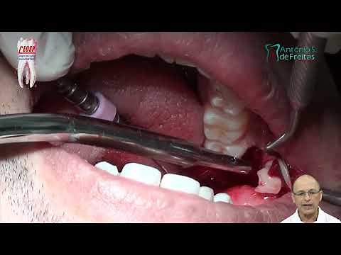 Cirurgia de siso deitado em militar de 30 anos. Dr Antônio Sérgio F Freitas