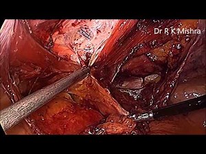 Master Class of Laparoscopic Repair of Incisional Hernia  • Video • MEDtube.net