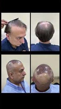 Hair Transplant Success Story | Patient Recommendation I Dr Mazhar Hussain