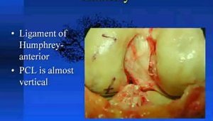 Posterior Tibial Inlay PCL Reconstruction
