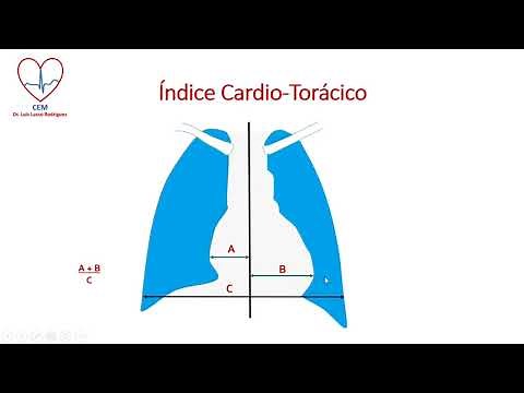 How to measure the cardiothoracic index (CTI) on a chest x-ray