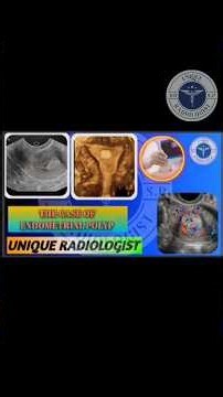 Primary Infertility with Endometrial Polyp | Ultrasound & Color Doppler Explained