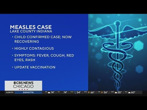 Measles case reported in Lake County, Indiana