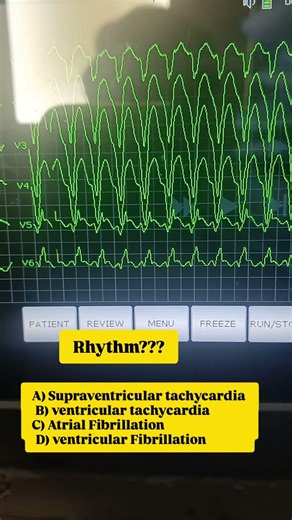 heart rhythm? how would you manage it? #cardiologia #cardiology #cardiology #nurse