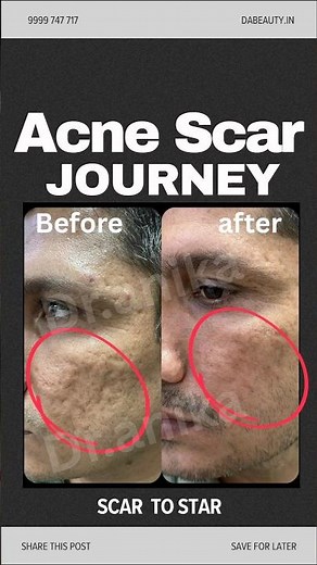 Acne scar result with laser treatment ll✨Before after #ActivateYourGlow #explore