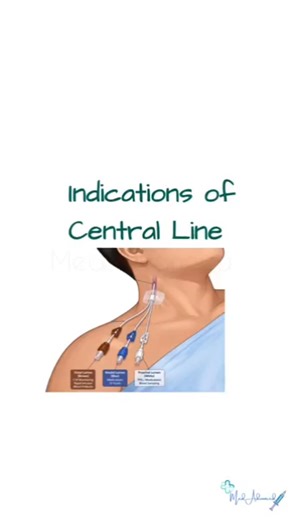 Central Line Indications | ICU Basics