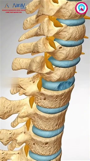 ACDF removes a damaged disc, relieves nerve pressure, reduces neck/arm pain,