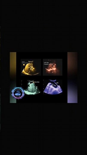 Chronic Liver Disease with gross Ascites | Ultrasound Case