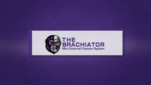 Animation: The Brachiator™ Mini External Fixation System
