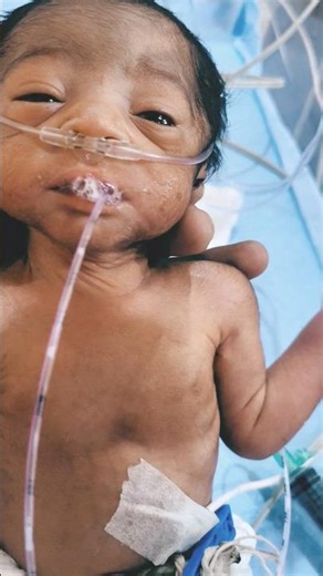 NewbornBaby NG Tube Removal Procedure 🥰| How an NG Tube Is Safely Removed #NewbornBaby#NGTubeRemoval