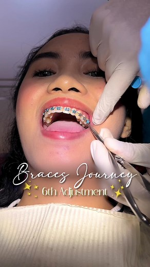 6th Brace Adjustment Journey | Colorful Braces Update