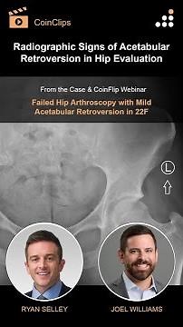 Radiographic Signs of Acetabular Retroversion in Hip Evaluation