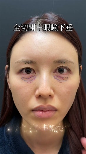 三重やくぼみ目は眼瞼下垂手術で治ります #くぼみ目 #三重 #眼瞼下垂