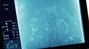 Targeting Cancer: Patients benefit from multidisciplinary treatments for liver cancer