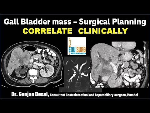 Gall Bladder cancer Surgical planning on CT scan- Triphasic CT liver protocol - Correlate clinically