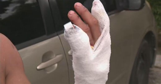 Hialeah man describes terrifying shark attack off Boca Chita Key in Biscayne Bay