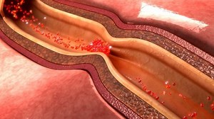 Conditions - International Heart Spasms Alliance