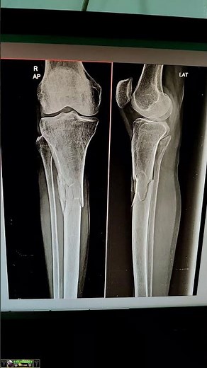 Tibia bone fracture #radiology