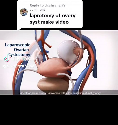 Ovarian Cyst Laparoscopy Surgery Procedure Explained