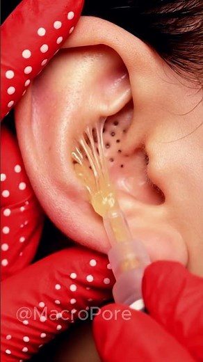 EAR BLACKHEAD REMOVAL — SO CLEAN 😳
