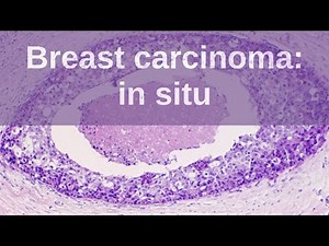 Breast Carcinoma: in situ - Pathology mini tutorial