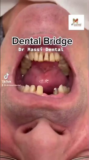 DENTAL BRIDGE 🦷😬