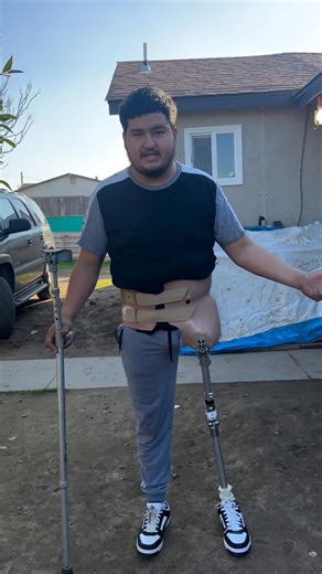 Above Knee Amputee Walks Again | Strong Young Man’s Inspiring Prosthetic Journey #prosthetics