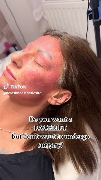 Then you need plasma fibroblast in your life!! 💥 Plasma fibroblast therapy is a non-invasive cosmetic treatment that uses a plasma device to create tiny micro-injuries on the skin’s surface. This stimulates collagen and elastin production, leading to skin tightening and rejuvenation. Here are the benefits of a full-face plasma fibroblast Skin Tightening & Lifting Helps reduce sagging skin, particularly around the eyes, jawline, and neck. Creates a firmer, more youthful appearance. Wrinkle Reduc