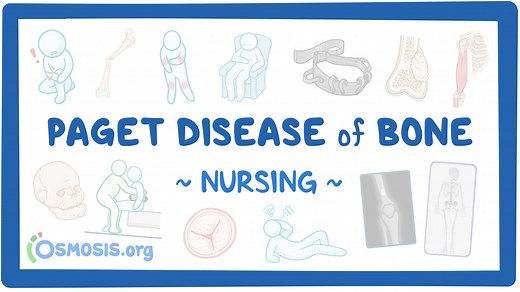 Paget disease of bone: Nursing: Video & Causes | Osmosis