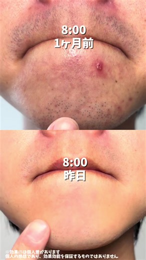 顎ニキビのループでお悩みのみなさま！ カームセブン使ってみて！ 繰り返すニキビ、全く消えないニキビ跡がマジでツルスベ肌になった✨
