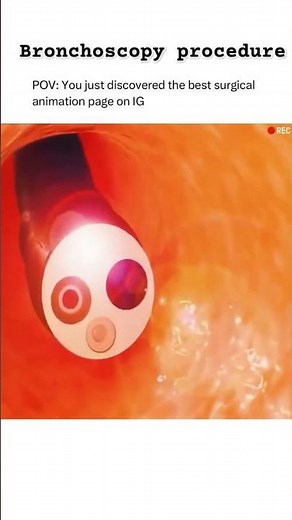 Bronchoscopy Procedure 3D animation #bronchoscopy #bronchitis #bronchi #bronchialasthma #shortsvideo