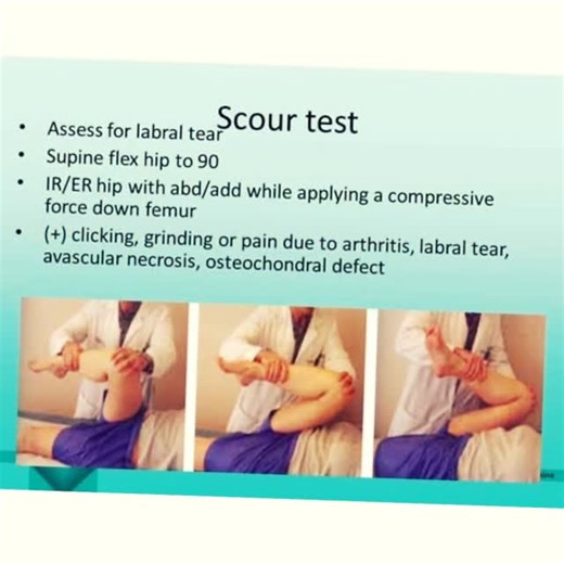 David Weinstock on Instagram: "The Scour test, or circumduction of the hip joint, is a great way to assess a torn labrum or pectineal pinch. NKT uses the result of this test to determine its course of action. For a pectineal pinch we test the pectineus vs the psoas, etc. https://www.youtube.com/watch?v=tkxfw3Xz_sQ (Link in profile). #nkt #neurokinetictherapy #scourtest #hips #pectineus #labrum #arthritis"